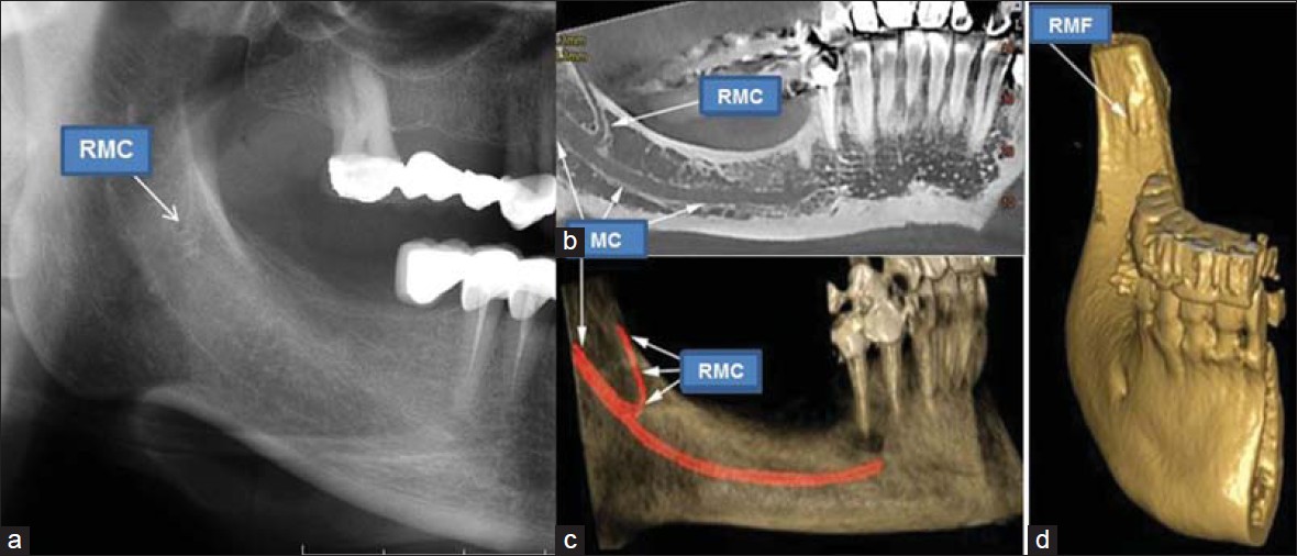 Mandibula CRANEX3D